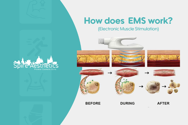 EMS treatment for post pregnancy weight loss treatment Edgbaston