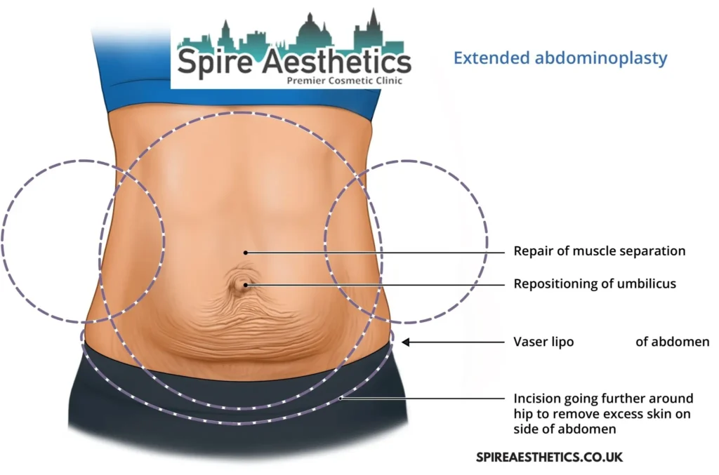 Understanding Loose Skin After Gastric Band Edgbaston Surgery and HIFU Treatment