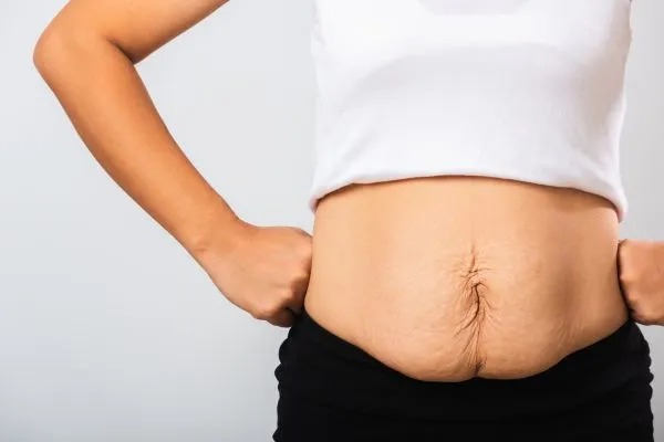 Image of a woman's stomach after weight loss with sagging skin following a gastric band Edgbaston