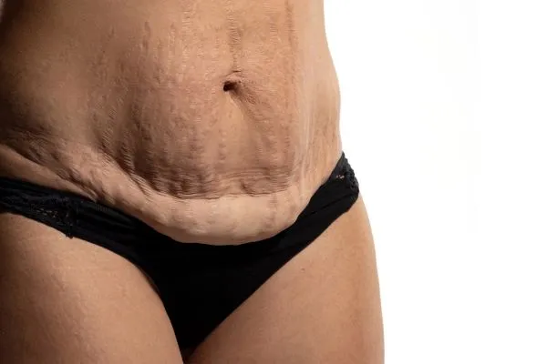 Image of womans stomach after weight loss injections Edgbaston showing saggy skin
